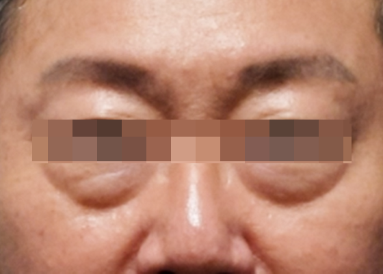 눈매주름 시술 전