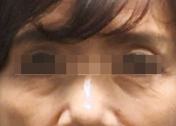 눈매주름 시술 전