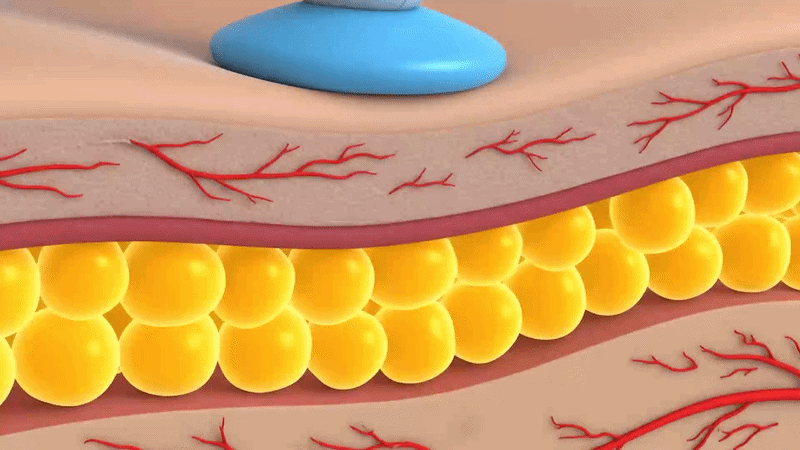지방축소레이저 원리