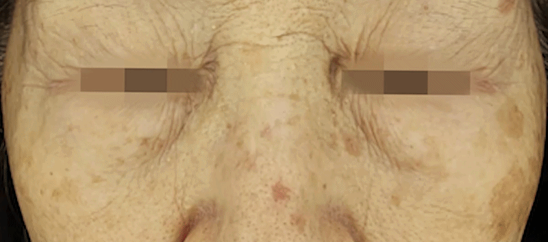 지방축소레이저 시술 부위