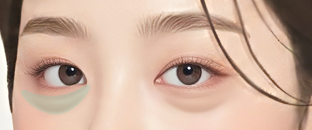 눈밑 리리핏 솔루션 효과