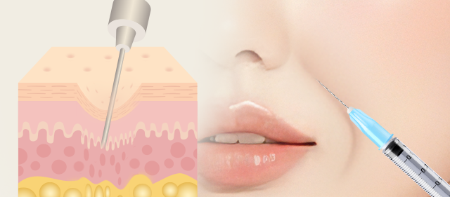 콜라겐 재생 주사