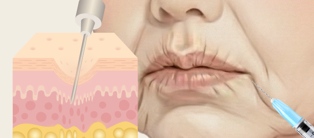 콜라겐 재생 주사