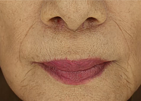 이마주름 시술 전