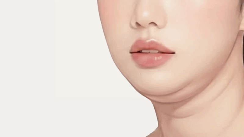 눈밑고랑주름재생주사