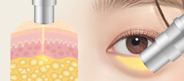 지방축소 레이저