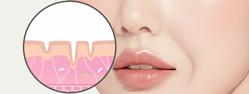 팔자주름 리리핏 원리