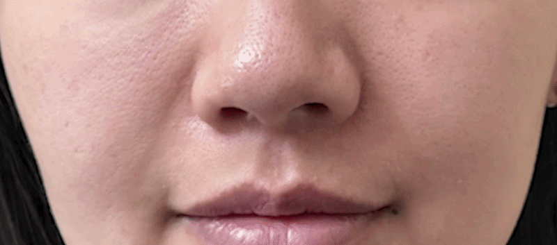 지방축소레이저 시술 부위