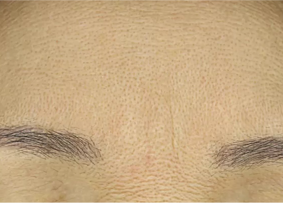 이마주름 시술 전