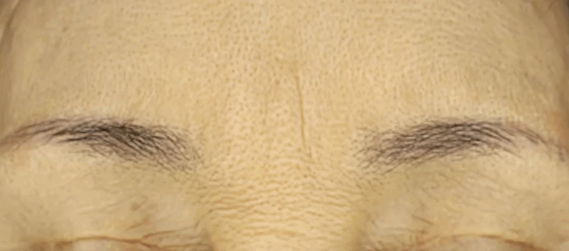 이완수축레이저 시술 부위